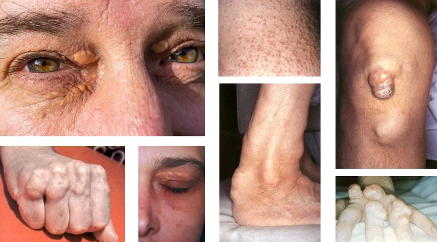 Ксантомы сухожилий