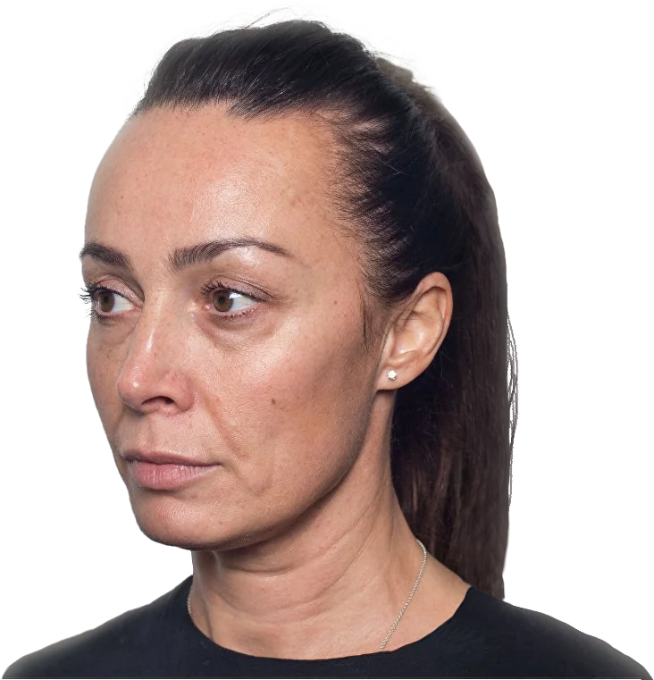 Состояние кожи до процедуры
