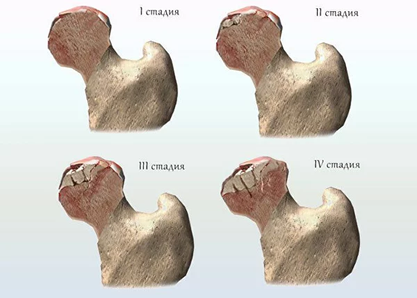 Асептический некроз головки бедренной кости — лечение в Запорожье