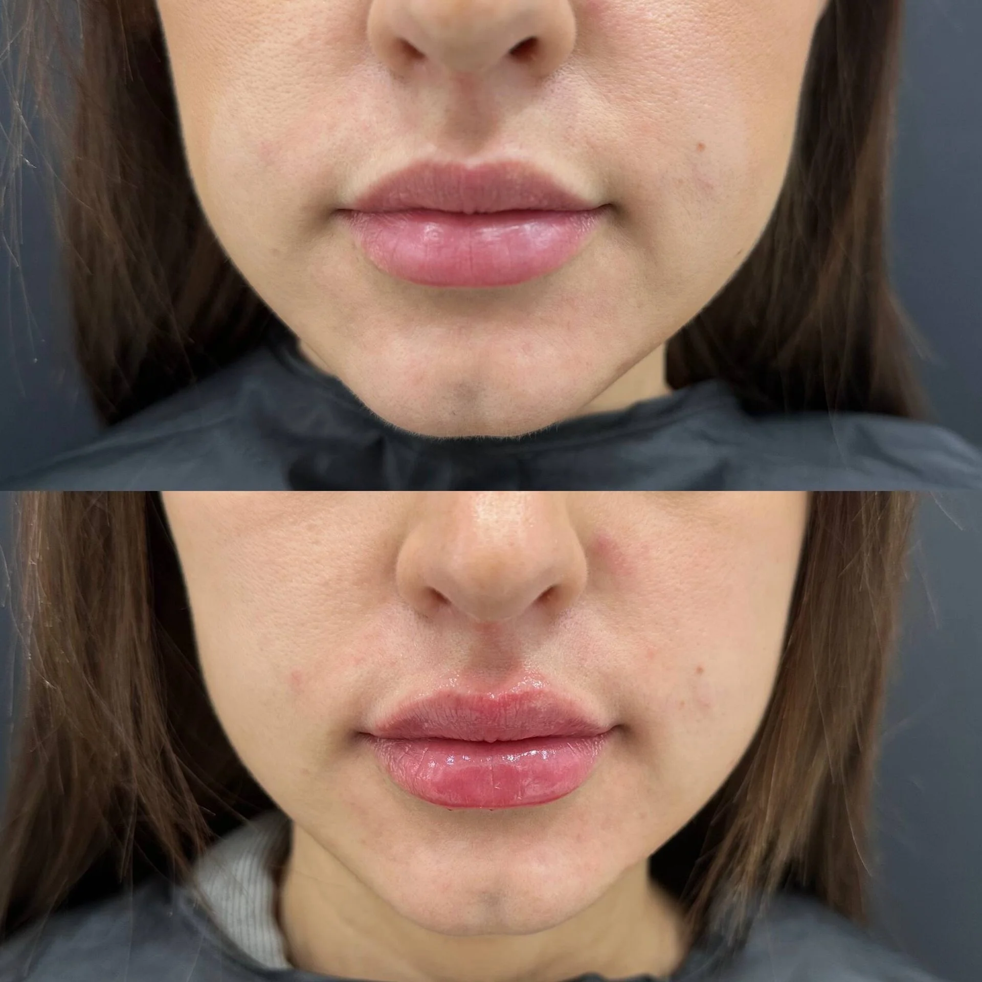Увеличение губ до и после — Флодия Калидж, DR. FLODYA CLINIC