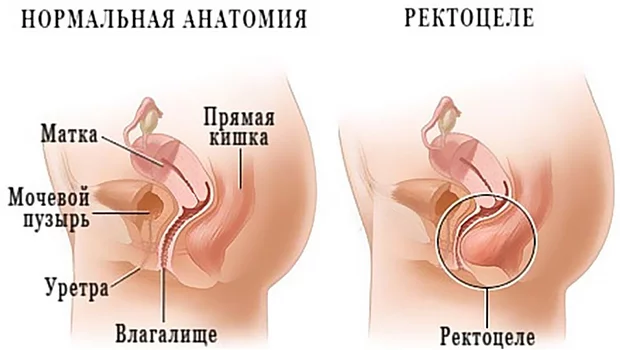 Опущение и выпадение влагалища и матки - Медицинский центр «ПОДМОСКОВЬЕ» г. Жуковский