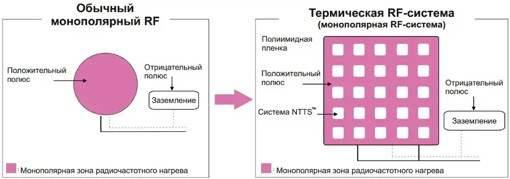 Сравнение обычного биполярного RF и фракционной RF-системы AFMR