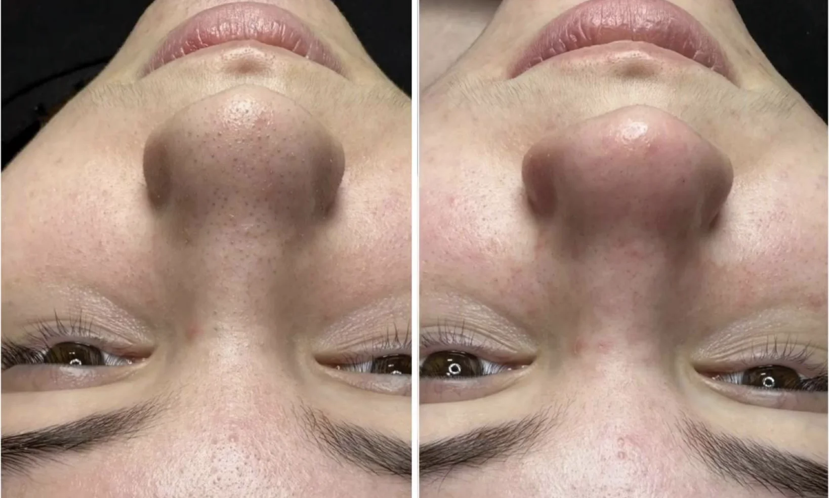 Before and after HydroDermabrasion results showing visibly cleaner pores and fewer blackheads at Beauty Studio by Hanna