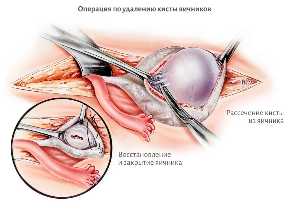 Сперматоцеле (удаление кисты яичка) – лечение в Москве в клинике доктора Назимовой