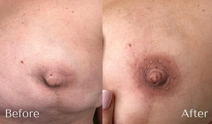 Большая ареола соска – Информация от Клиники Grandmed
