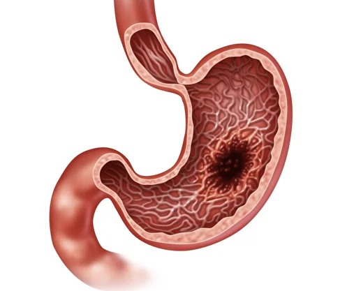 Рак желудка: Опасный и скрытый рак, который можно выявить рано (Руководство 2026)