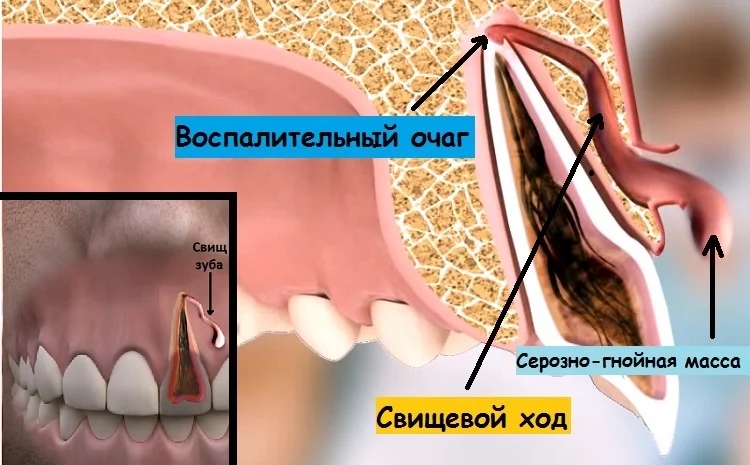 Симптомы и лечение гнойного абсцесса корня зуба | Colgate®