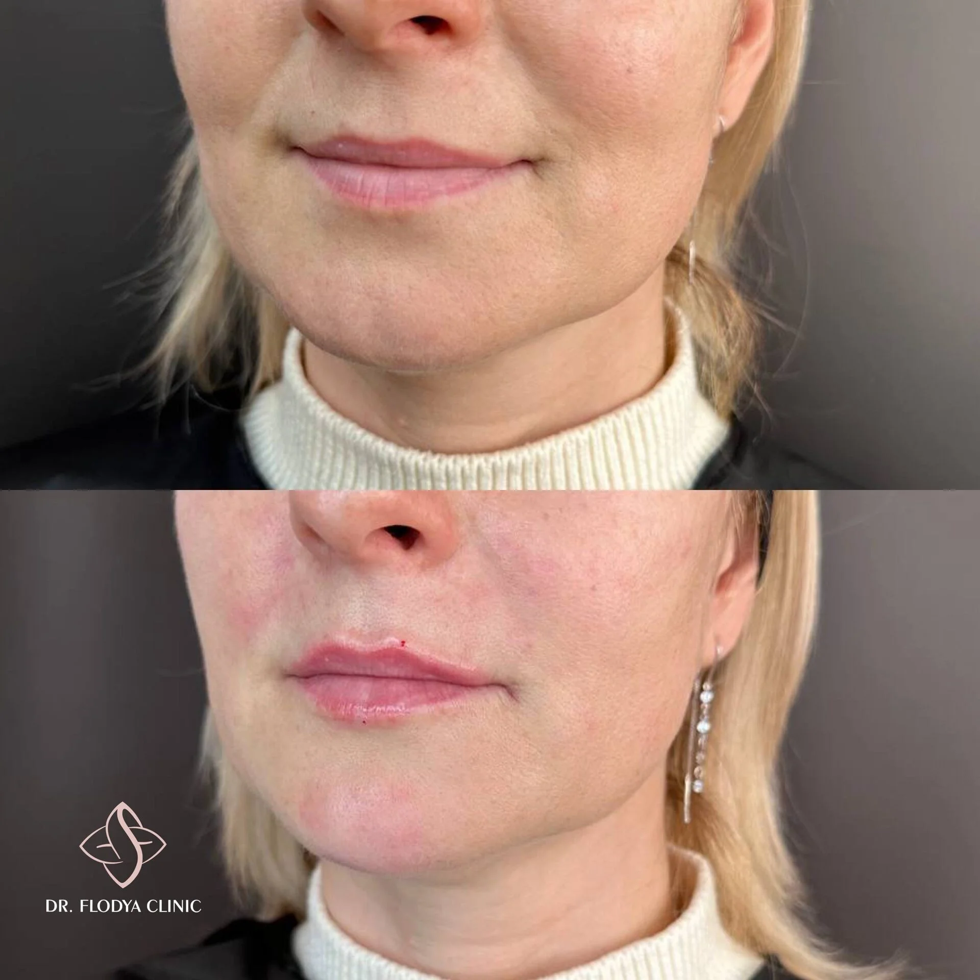 Контурная пластика губ до и после — DR. FLODYA CLINIC