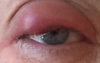 халязион века — клиническая картина