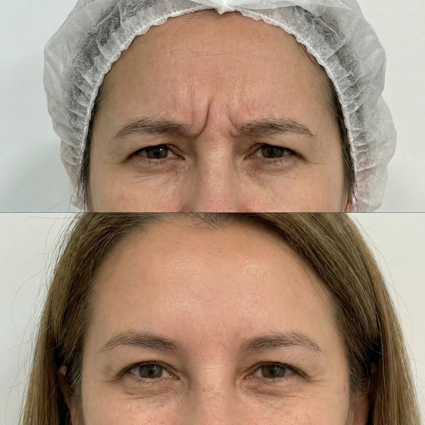 До и после — Полная коррекция