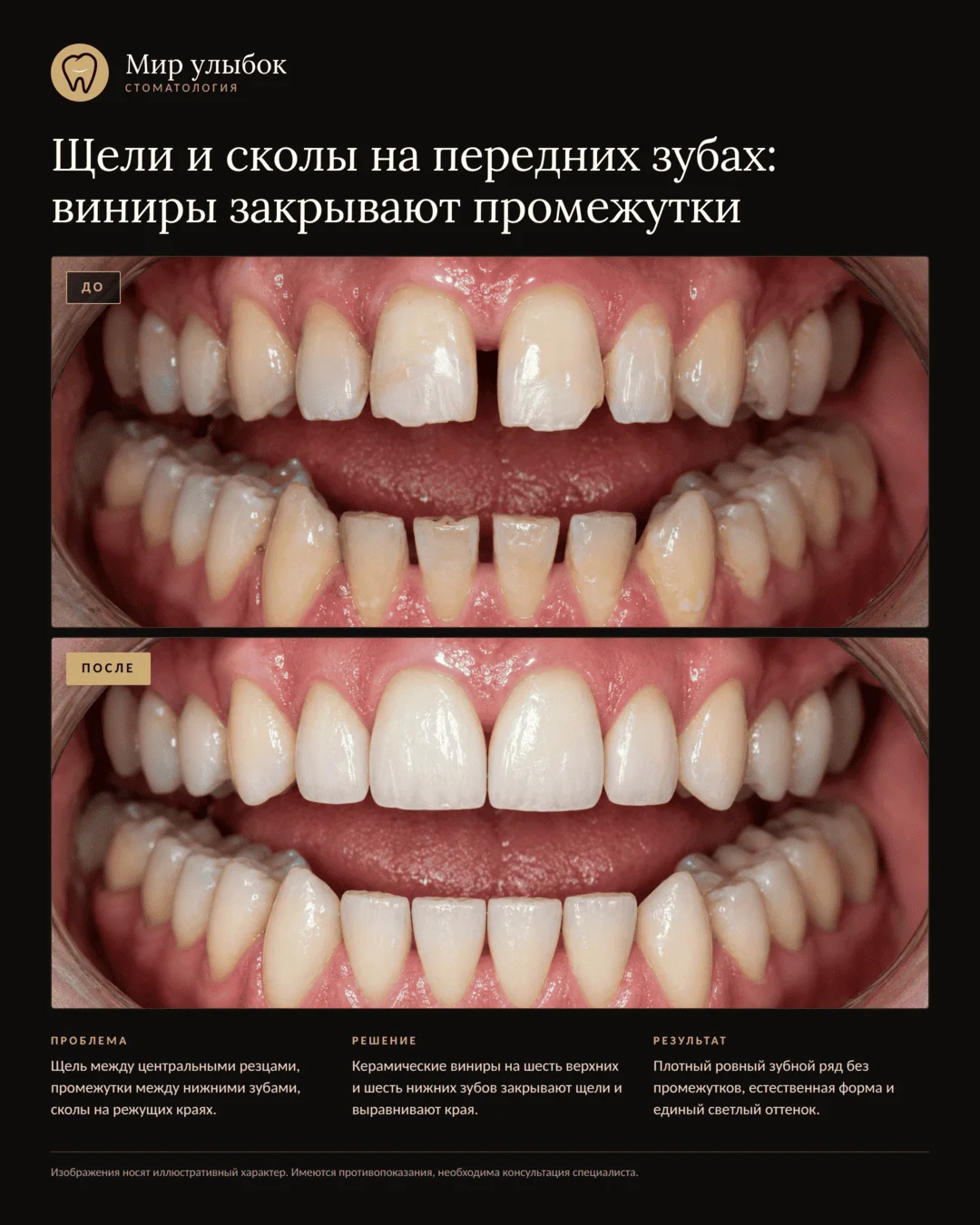 Пример работы стоматологии «Мир улыбок»: виниры
