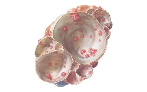 Қынапта серозды киста Қынапта серозды киста