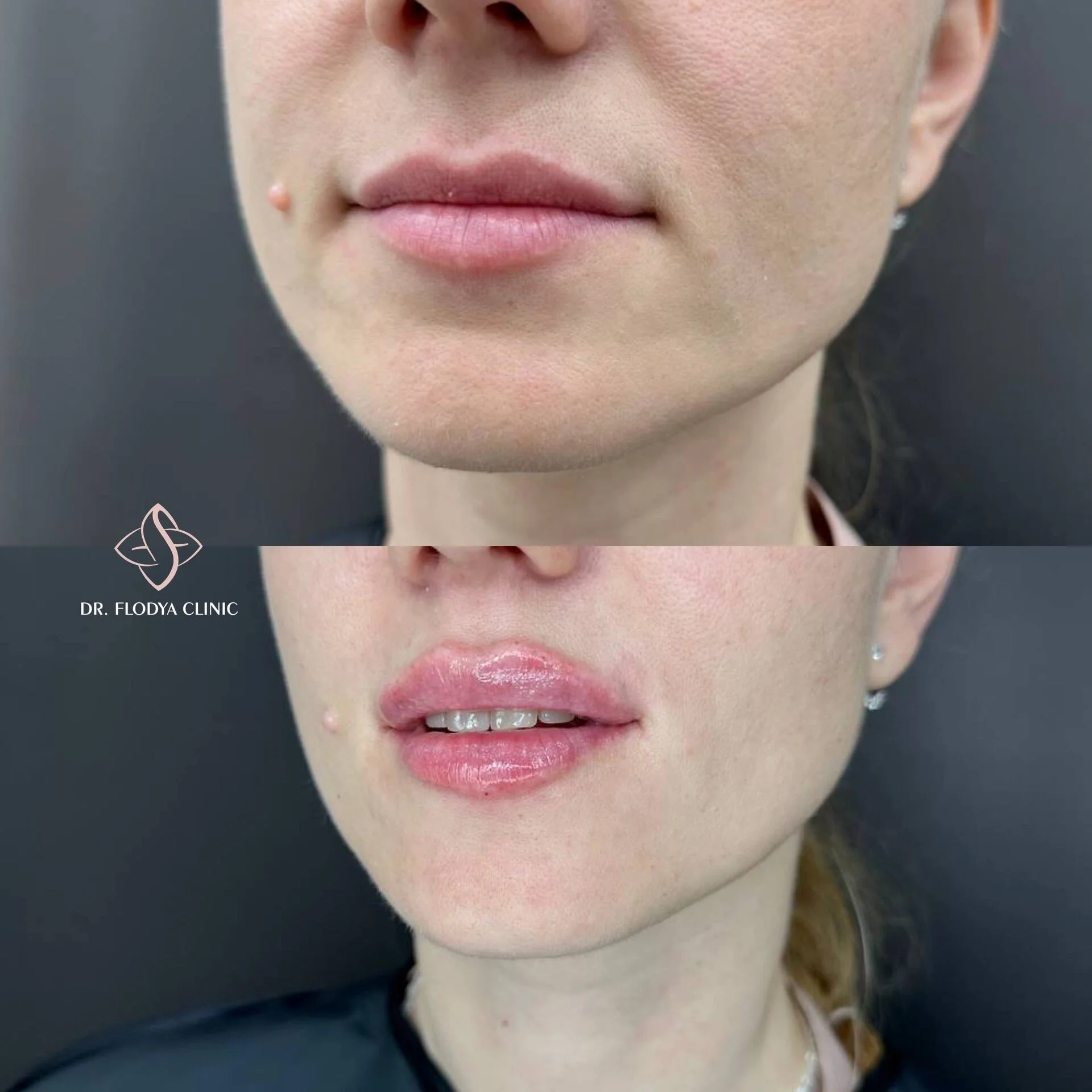 Контурная пластика губ до и после — DR. FLODYA CLINIC