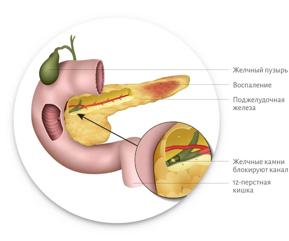 Панкреатит поджелудочной железы: симптомы и лечение | Клиника Рассвет