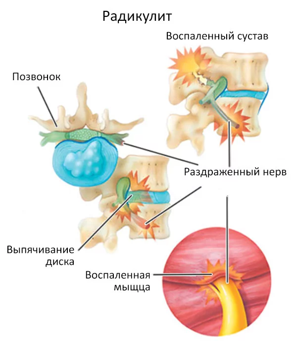 Радикулит поясничного, грудного и шейного отделов позвоночника – принципы его лечения