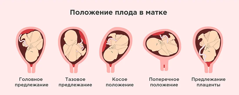 Приемы Леопольда-Левицкого Для определения расположения плода в матке используют