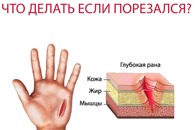 «Острый» вопрос! Первая помощь при порезах - я городская детская поликлиника