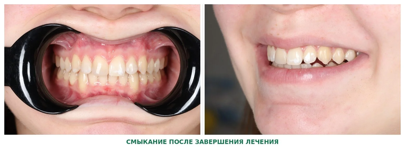Лечение элайнерами: фронтальный вид с ретракторами до и после