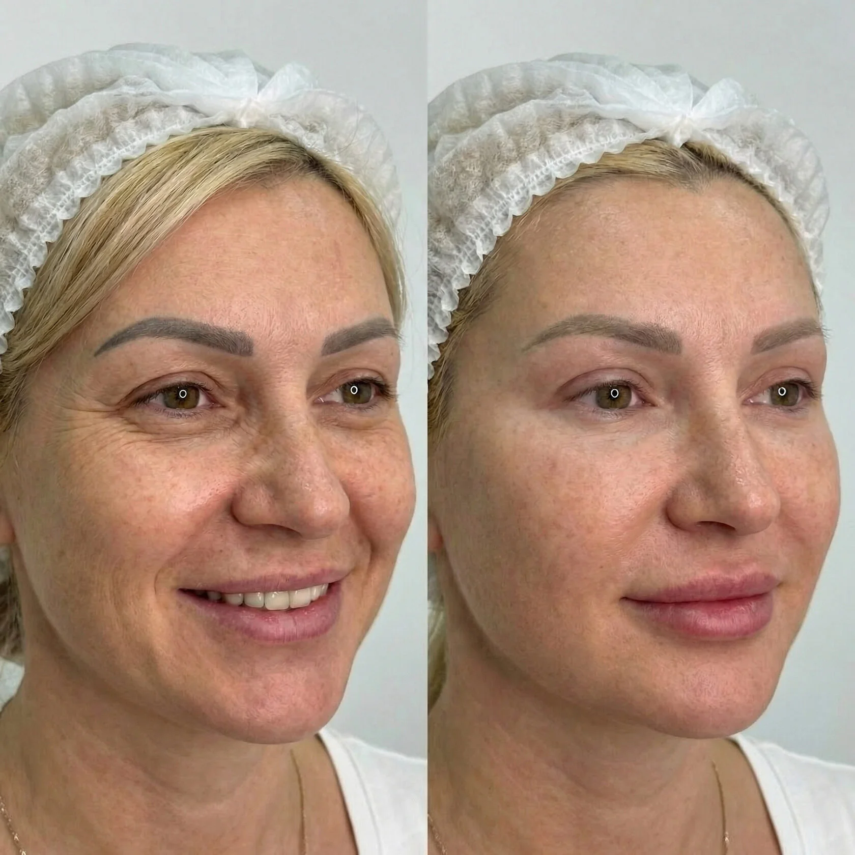 До и после — Лоб