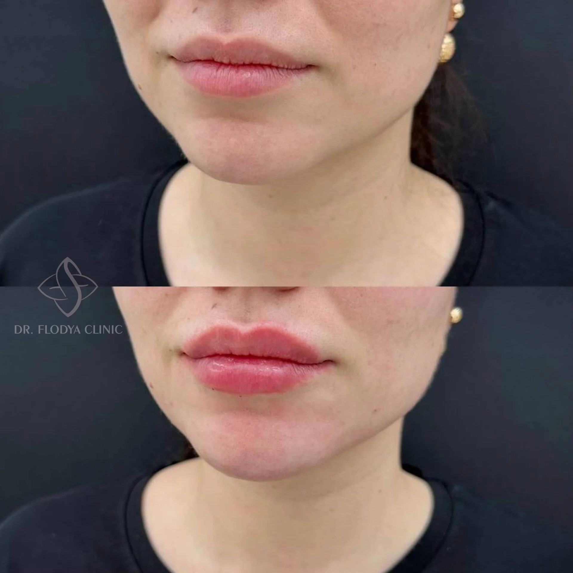 Коррекция формы губ до и после — DR. FLODYA CLINIC